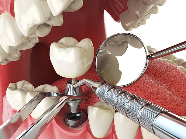 Best Emergency Treatment for Dental Infections or Abscesses in Jordan, NY